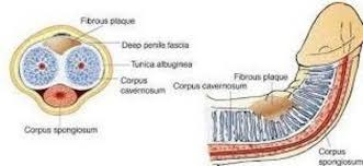 fibrosis de pene miguel moises fibrosis de pene miguel moises